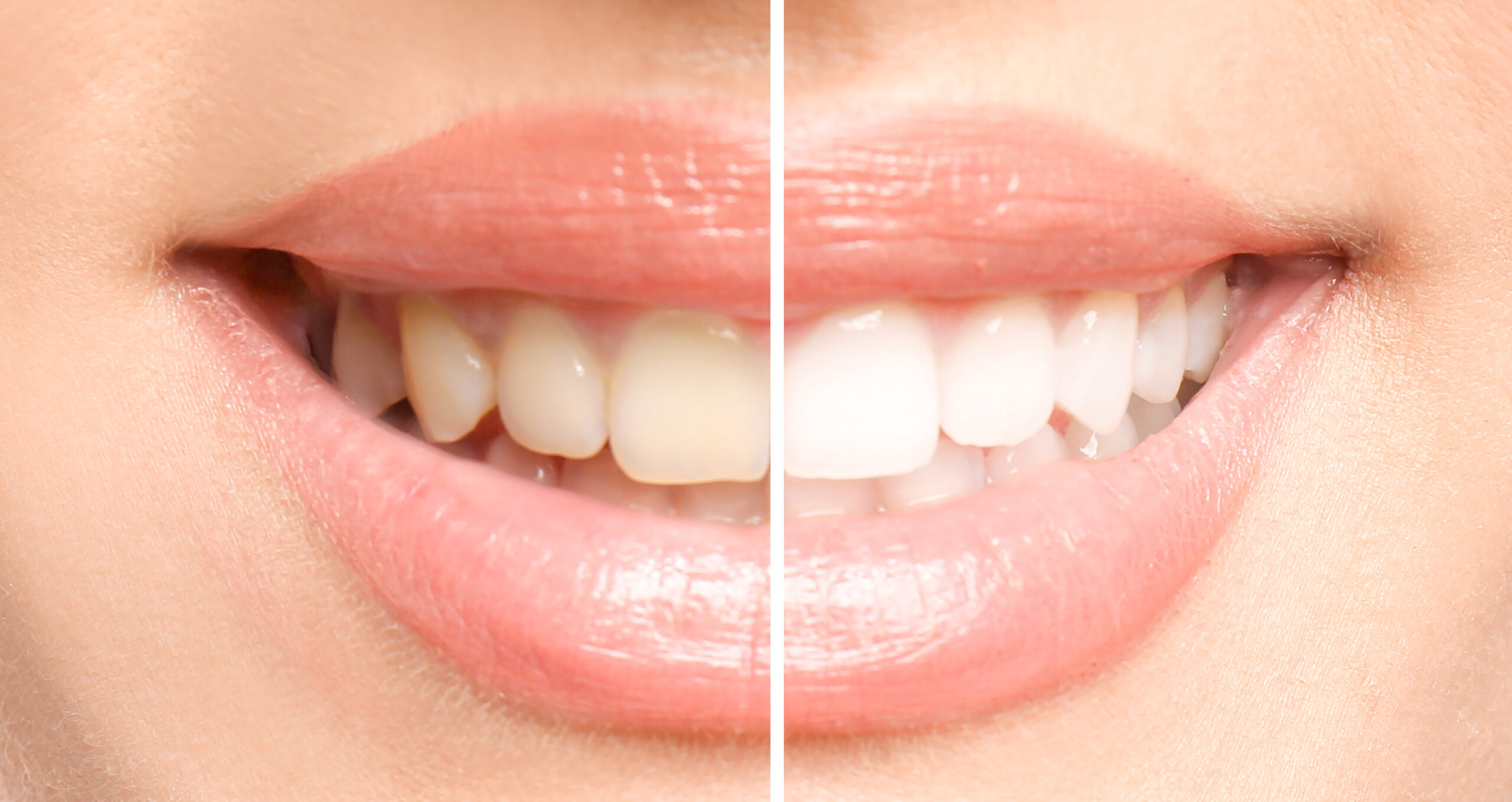 Smiling woman before and after teeth whitening procedure, closeu